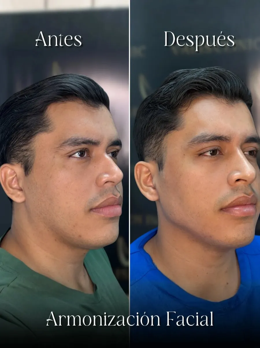 Antes y después de armonización facial en paciente masculino
