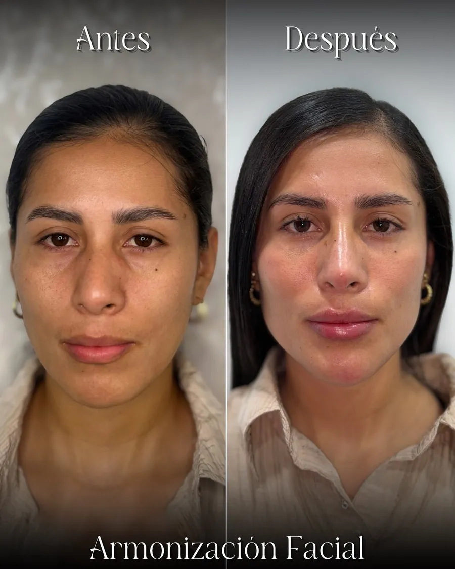 Antes y después de armonización facial en paciente joven
