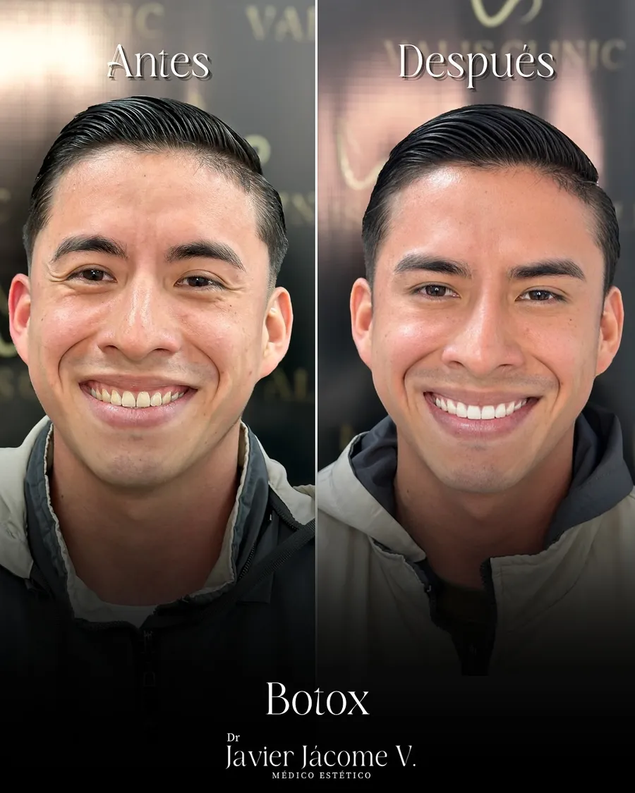 Antes y después de tratamiento con Botox