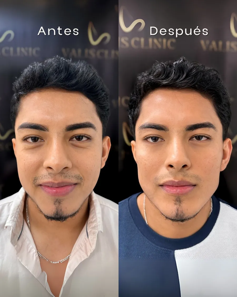 Antes y después de tratamiento facial completo